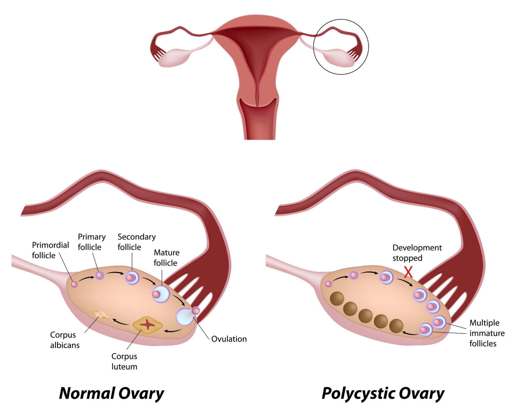 I-fern Products. 001 - What is Ovarian Cyst? An ovarian cyst is a